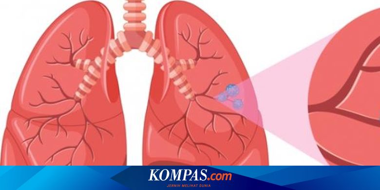 Teka Teki Kanker Paru Mengapa Ada Perokok Yang Tak Kena Halaman All Kompas Com