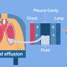 Efusi Pleura