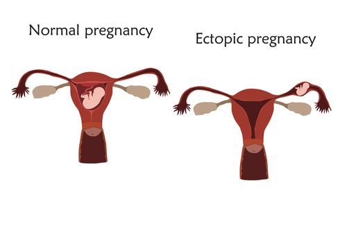 Kehamilan Ektopik