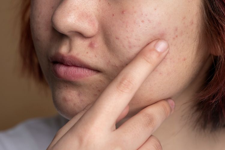 Kojic acid disebut bisa mengatasi flek hitam tanpa iritasi. Dokter menjelaskan cara kerja dan waktu yang dibutuhkan untuk melihat hasilnya.