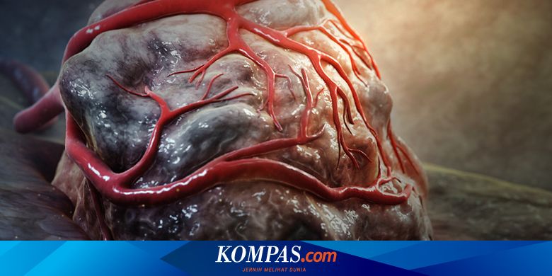 Kisah Dokter Bedah di Jerman Tak Sengaja Pindahkan Tumor Pasien ke Tangannya, Kok Bisa?