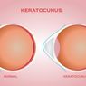 Keratoconus