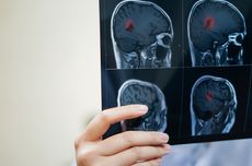 4 Jenis Tumor Otak, dari Ringan hingga Ganas