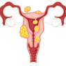 Mioma Uteri
