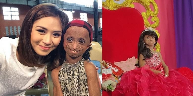 Kenali Penyakit Langka Progeria Yang Membuat Anak Menjadi Tua Halaman All Kompas Com