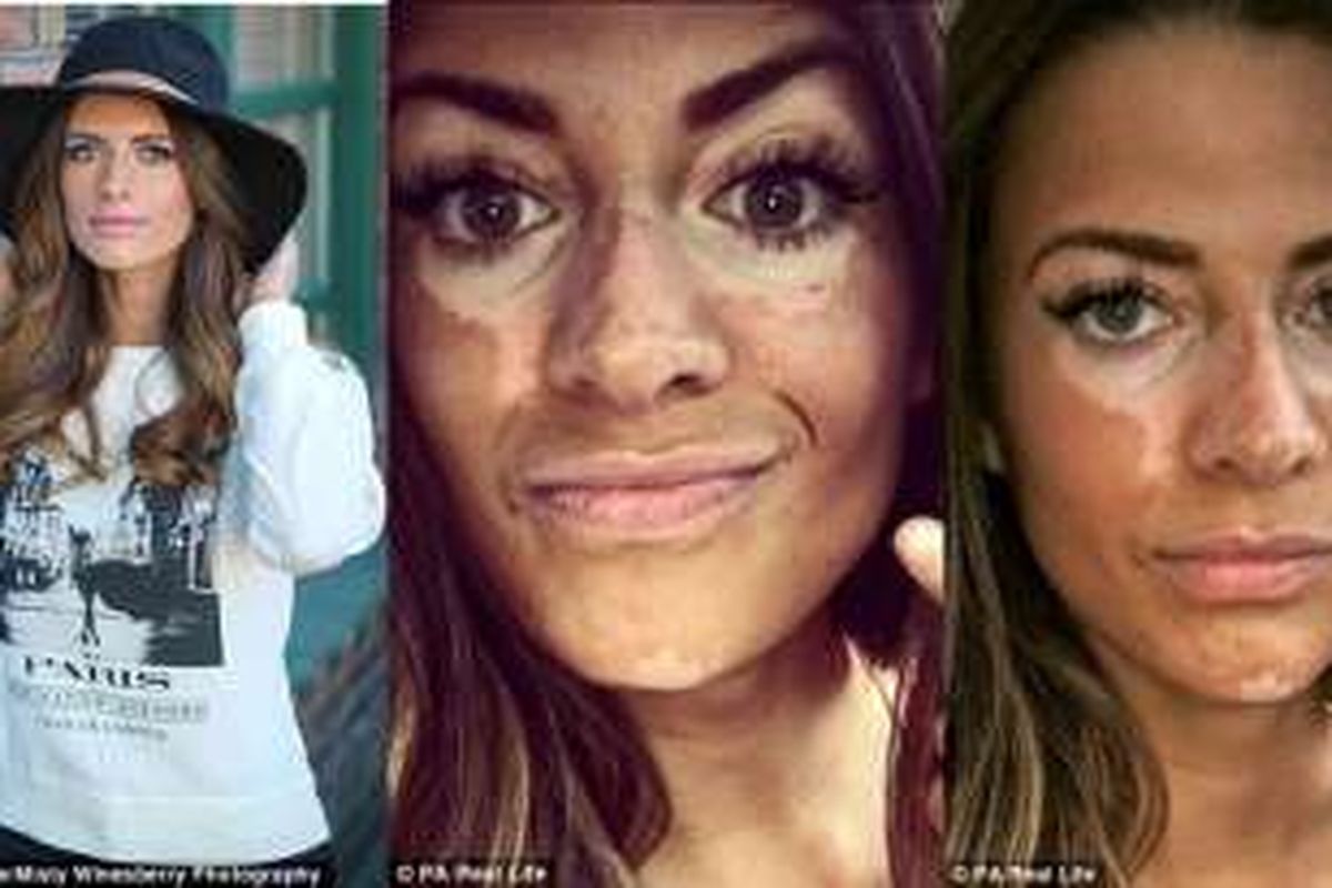 Kondisi kulit vitiligo model bernama Breanne Rice