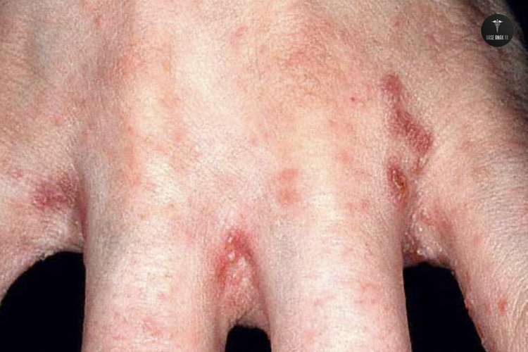 Rash Webs Of Fingers