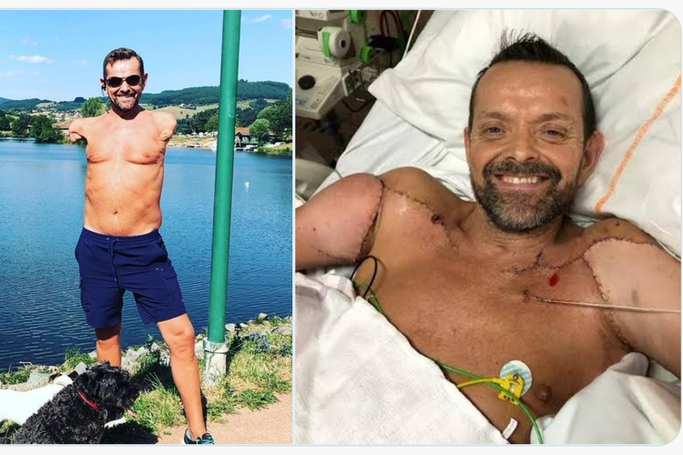Felix Gretarsson (49 tahun), dari Lyon, Perancis, terpaksa diamputasi kedua lengannya setelah dia disetrum di tempat kerja pada 1998 di Kópavogur, Islandia.
