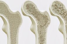 Cara Mencegah Osteoporosis yang Penting Dilakukan Sebelum Terlambat