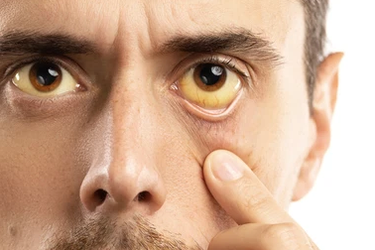 Penyakit kuning ditandai dengan perubahan warna mata dan kulit menjadi kekuningan. 