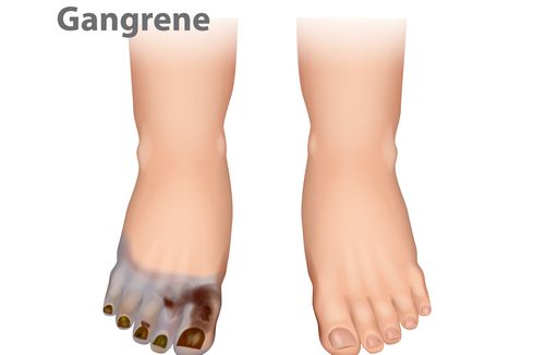 3 Penyebab Gangren, Kondisi Medis yang Bisa Sebabkan Amputasi