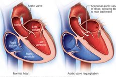 Penyebab Aneurisma Aorta dan Gejalanya