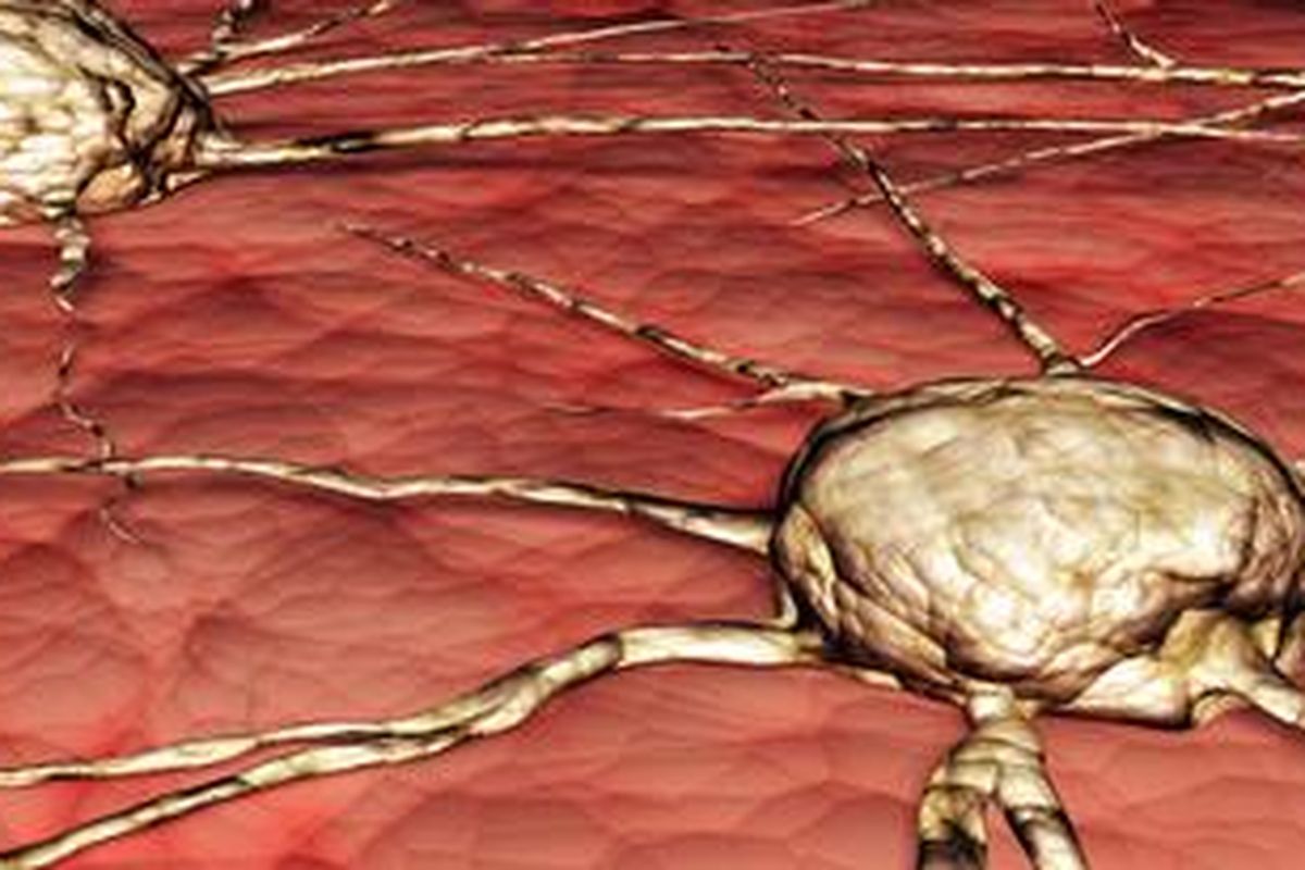 Ilustrasi sel kanker