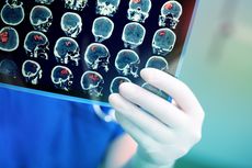 Apakah Penyakit Kanker Otak Bisa Sembuh?