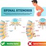Stenosis Spinal (Tulang Belakang)
