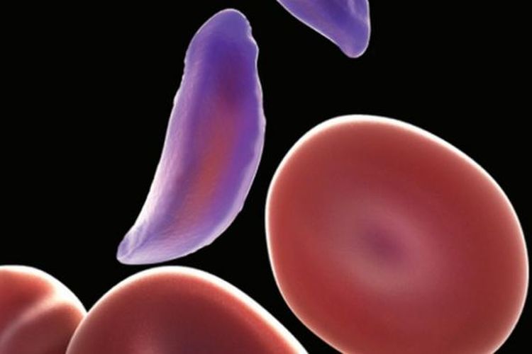 Ilustrasi sel darah merah berbentuk bulan sabit yang menyebabkan anemia. Penyebab anemia sebagian besar adalah karena kekurangan zat besi.