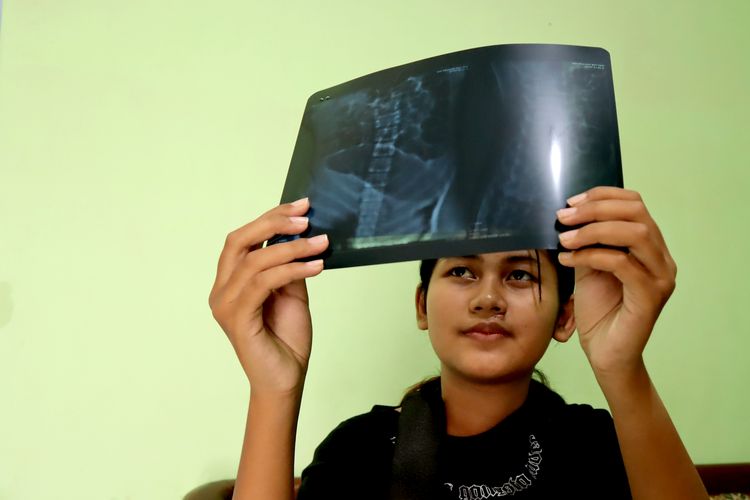 Korban Tragedi Kanjuruhan Verlitha Noor Zia melihat hasil rontgen di daerah Sukun, Senin (25/10/2022) sore.