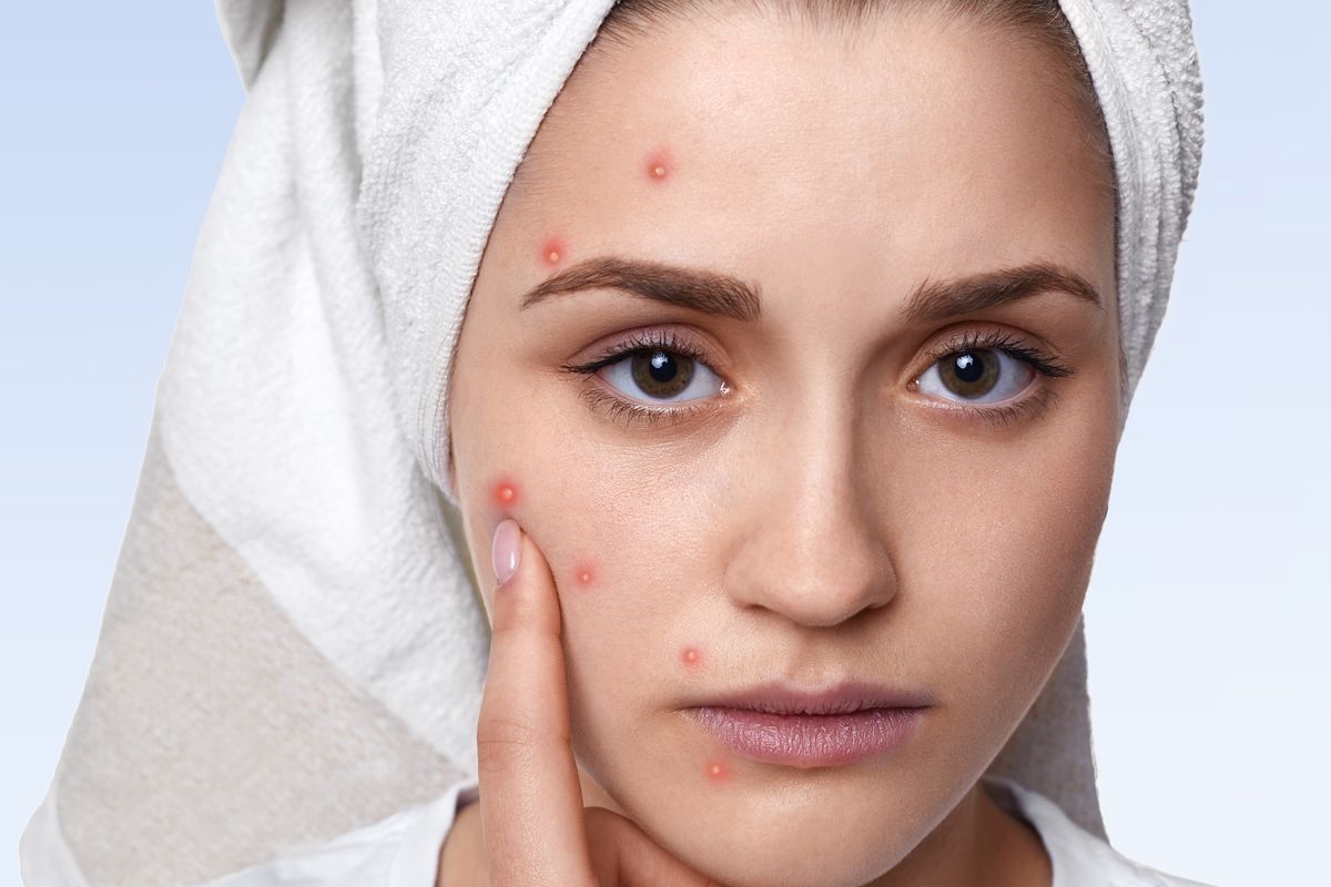 Mengetahui perbedaan rosacea dan jerawat sangat penting untuk bisa mendapatkan pengobatan dan perawatan yang tepat.