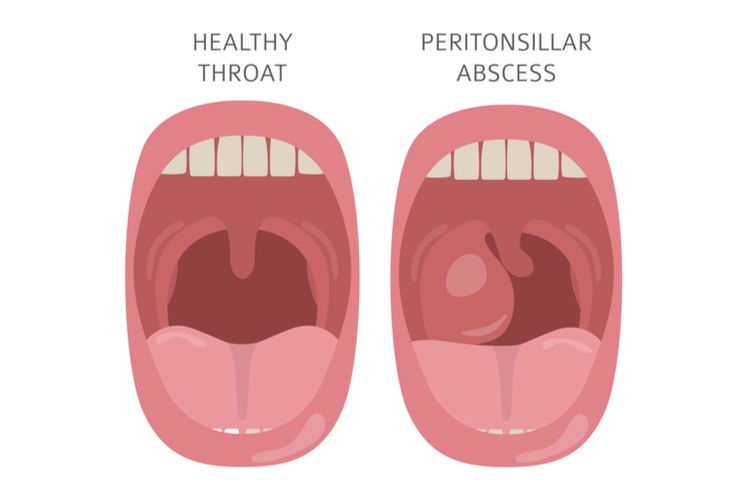 Ilustrasi abses peritonsil