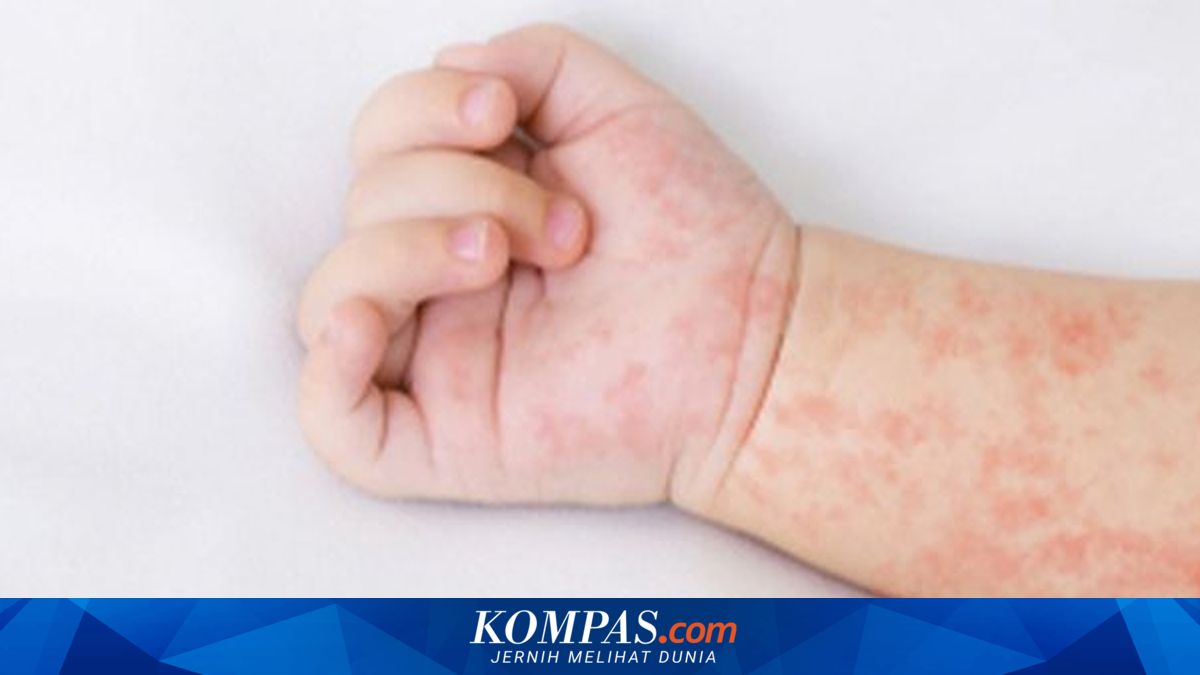 Hampir 1.000 Anak Meninggal Dunia akibat Wabah Campak Terburuk di Bangladesh