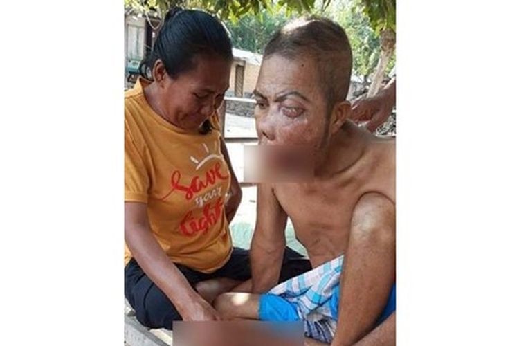 Tangkapan layar Sukirman (55), seorang warga NTB yang menderita tumor ganas di mulut.