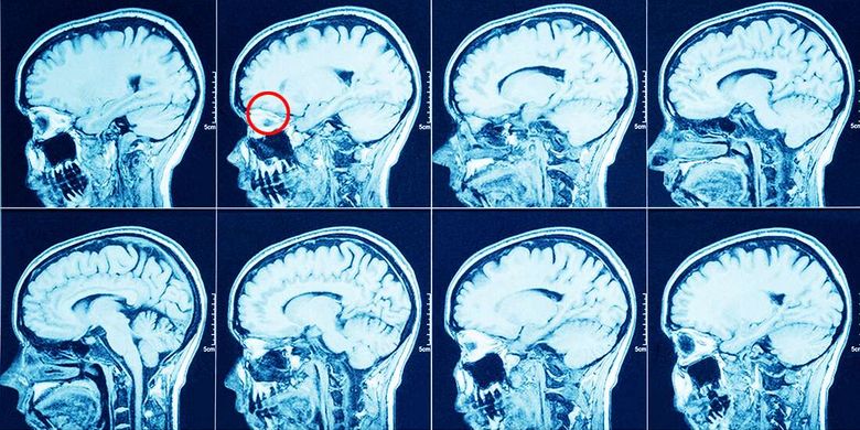 Ilustrasi hasil pemindaian MRI otak. Bagian yang dilingkari merah adalah area saraf penciuman.