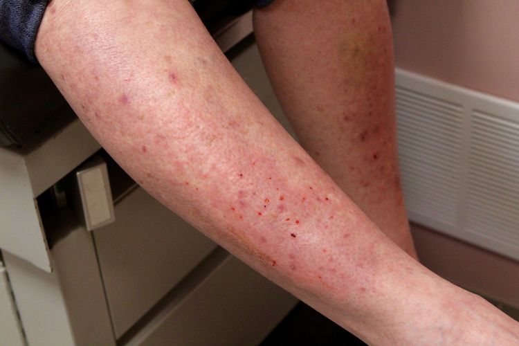 Ilustrasi Dermatitis Herpetiformis berupa ruam kulit akibat sensitivitas gluten