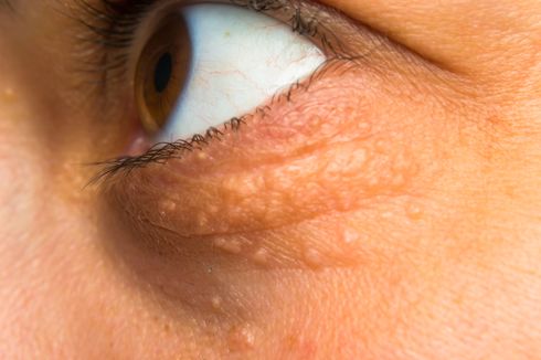 5 Tanda-tanda Kolesterol Tinggi pada Wajah dan Mata