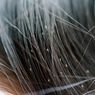5 Cara Mudah Menghilangkan Kutu Rambut