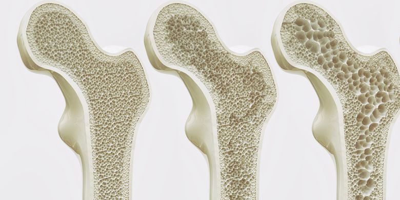 Ilustrasi osteoporosis. Sejumlah cara bisa Anda lakukan untuk mencegah osteoporosis yang semakin berisiko seiring bertambahnya usia.