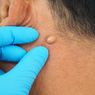 4 Gejala Kista Epidermoid yang Perlu Diwaspadai