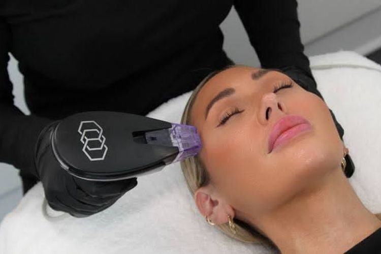 Perawatan pengencangan kulit wajah Morpheus8.