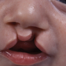 Bibir Sumbing