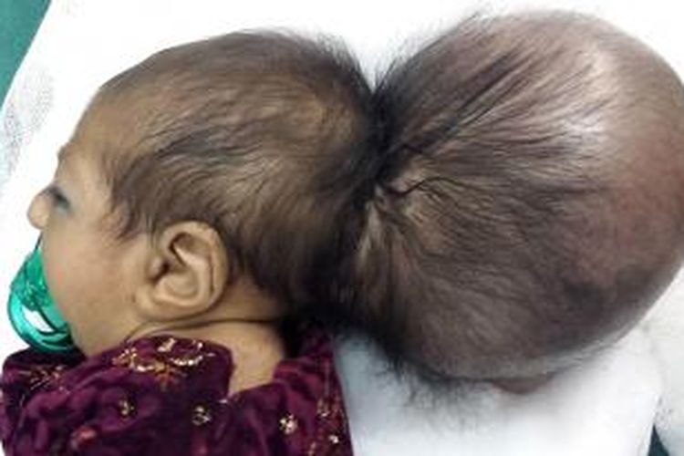 Kondisi bayi Asree Gul dan kepala tambahannya sebelum pembedahan. Tim dokter rumah sakit Jalalabad, Afganistan berhasil membuang kepala tambahan di kepala Asree Gul yang baru lahir ini.