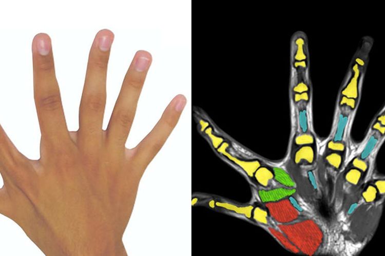 Hasil pindaian tangan pengidap polidaktili yang menunjukkan bahwa jari ekstra digerakkan oleh otot tersendiri 