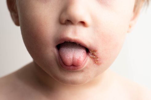 2 Penyebab Herpes Pada Bayi, Orangtua Perlu Waspada