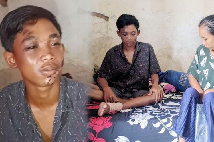 Nur Saguwanto (19) korban Tragedi Kanjuruhan menjalani pemulihan sendiri di rumahnya.