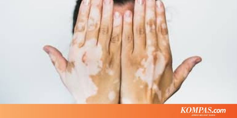 Vitiligo, Penyakit yang Sebabkan Seseorang Kehilangan Warna Kulit