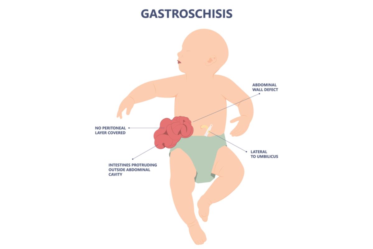 Ilustrasi gastroschisis