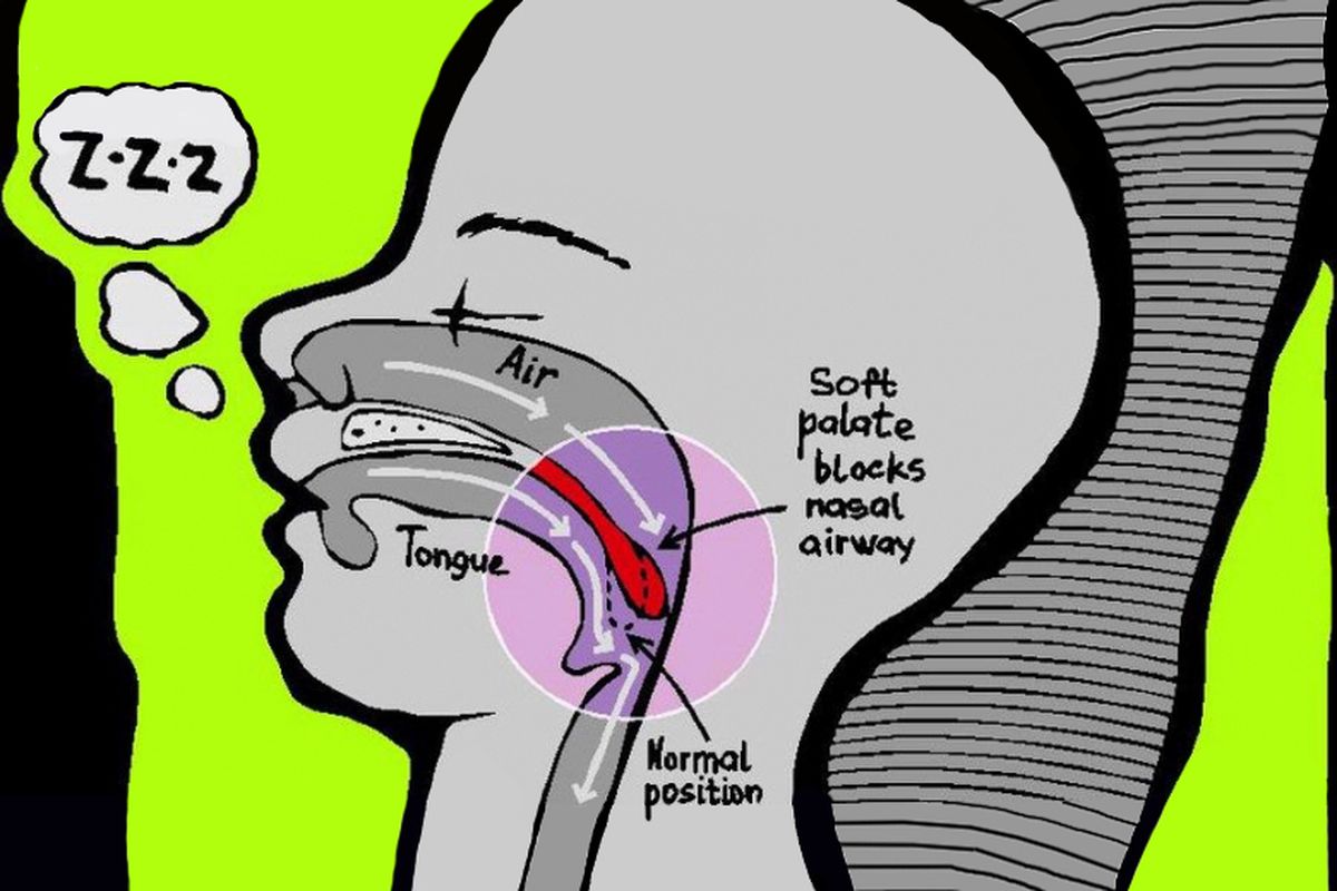 Ilustrasi anak mendengkur.