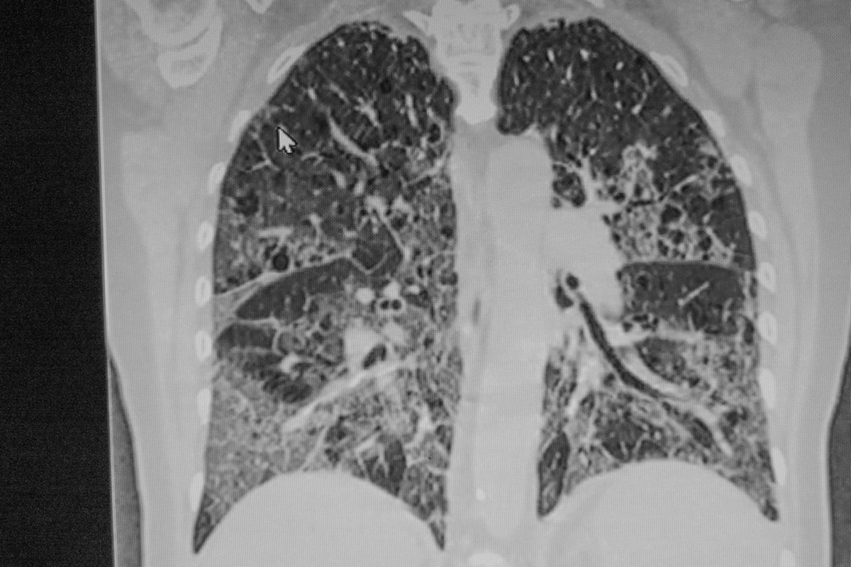 Hasil CT Scan paru pada pasien Covid-19 yang menunjukkan ground glass opacity