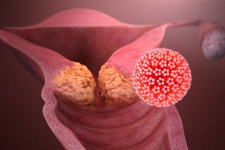 Human papillomavirus (HPV) yang menyebabkan kanker serviks 