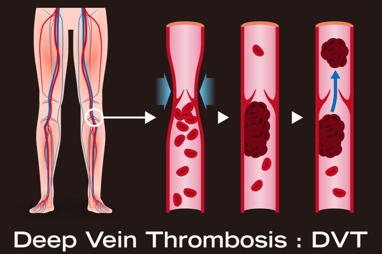 Ilustrasi Trombosis Vena Dalam atau DVT