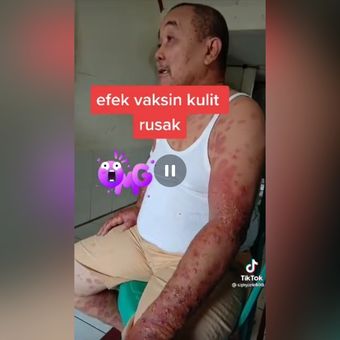 Potongan gambar dari video Efek Vaksin Kulit Rusak yang viral di TikTok.