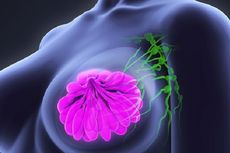 Lebih Agresif dan Bisa Kambuh, Begini Pengobatan Kanker Payudara Triple Negatif 