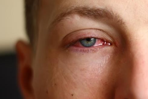 4 Penyebab Mata Merah dan Cara Menghilangkannya