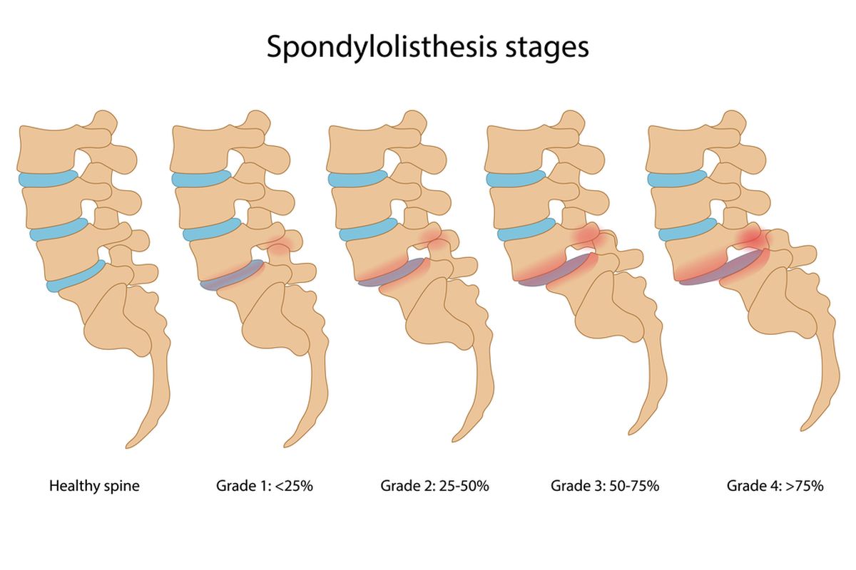 Ilustrasi Spondylolisthesis