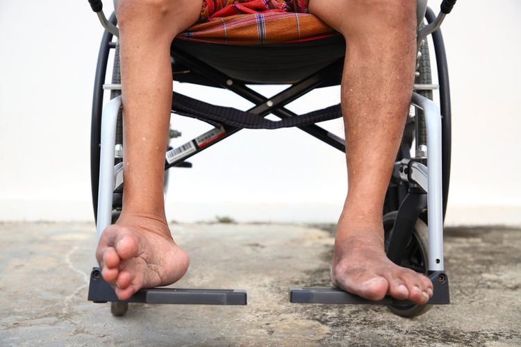 Ilustrasi polio, ilustrasi penderita polio, virus polio menyerang tubuh bagian apa