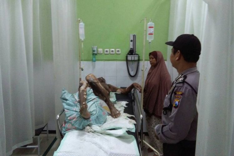 Inilah kakek Safari (79), warga Dusun Jrubong Utara,  Desa Jururejo Kecamatan Ngawi, Kabupaten Ngawi yang nekat bakar diri karena sakit yang tak kunjung sembuh. Nampak korban sementara dirawat di rumah sakit di Ngawi, Jumat ( 2/6/2017).