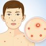 5 Ciri-ciri Infeksi HIV pada Kulit